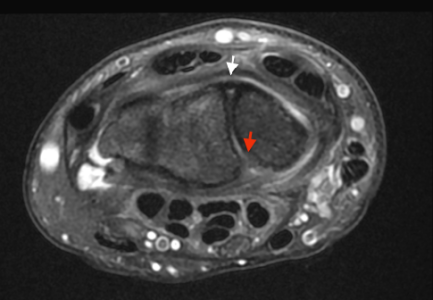 Perforation de la composante palmaire du ligament scapholunaire IRM