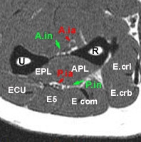 Anatomie du Nerf interosseux anterieur