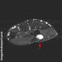 Eminence hypothénar douleur Eminence hypothénar douleur