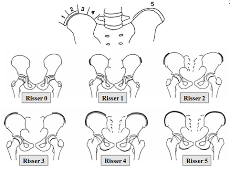 Test de Risser en fonction âge du patient