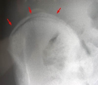 Test de Risser en fonction âge du patient