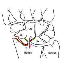 SLAC wrist et rupture du ligament scapho-lunaire