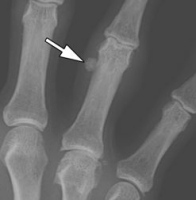 Calcification du doigt - Causes