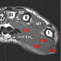 Oedeme eminence thenar Oedeme eminence thenar