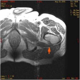 Métastases osseuses (2)