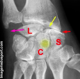 SNAC wrist en Radiographie