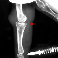 Fracture de la phalange intermediaire Fracture de la phalange intermediaire